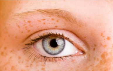 女人黃褐斑是怎么形成的？主要與這幾大因素有關(guān)