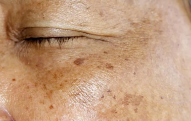 可怕的是老年斑，90后也不放過