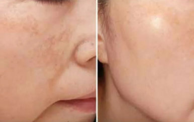 都說祛斑難，對不起，那是他因?yàn)槟銢]選對方法！